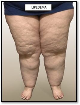 LIPEDEMA, DOENÇA CONFUNDIDA COM OBESIDADE, É TEMA DE WORKSHOP GRATUITO EM SP